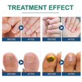 thumbnail image 3 of 96pcs Toenail Corrector Patches Ingrown Toenail Correction Stickers To Relieve Nail Groove Paronychia Treatment Patch Foot Care, 3 of 5