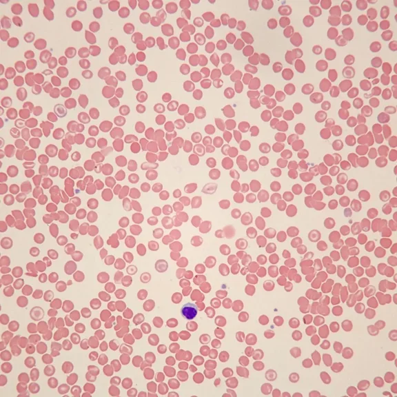 Human Sickle Cell Anemia Slide, Smear, Wright's Stain