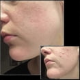 thumbnail image 5 of Adjustable Microneedle Derma Stamp For Hair Growth, 5 of 5