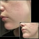 thumbnail image 4 of 2024 New Adjustable Microneedle Derma Stamp For Face Skin Acne Scar Repair And Hair Growth - Microneedling Derma Ro, 4 of 4