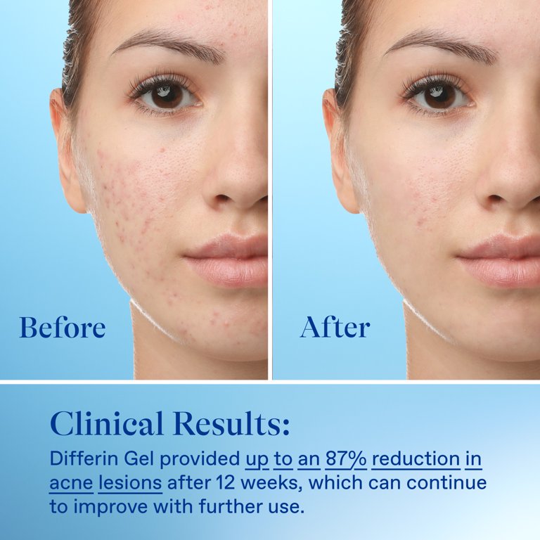 Differin acne clearance