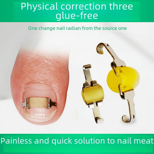 Parche para uñas, ranura para uñas, dispositivo de corrección de uñas, hebilla para uñas, parche para uñas, parche corrector de uñas, corrección de uñas