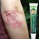 thumbnail image 2 of Crema antihongos para Psoriasis, tratamiento de infección por hongos para la piel, pomada médica para picazón, 2024, 2 of 4