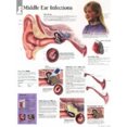 thumbnail image 1 of Publishing, S: Middle Ear Infections Paper Poster, 1 of 1