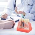 thumbnail image 6 of Dental Implant Model for Patient Education, 4 Times Dental Implant, 6 of 7