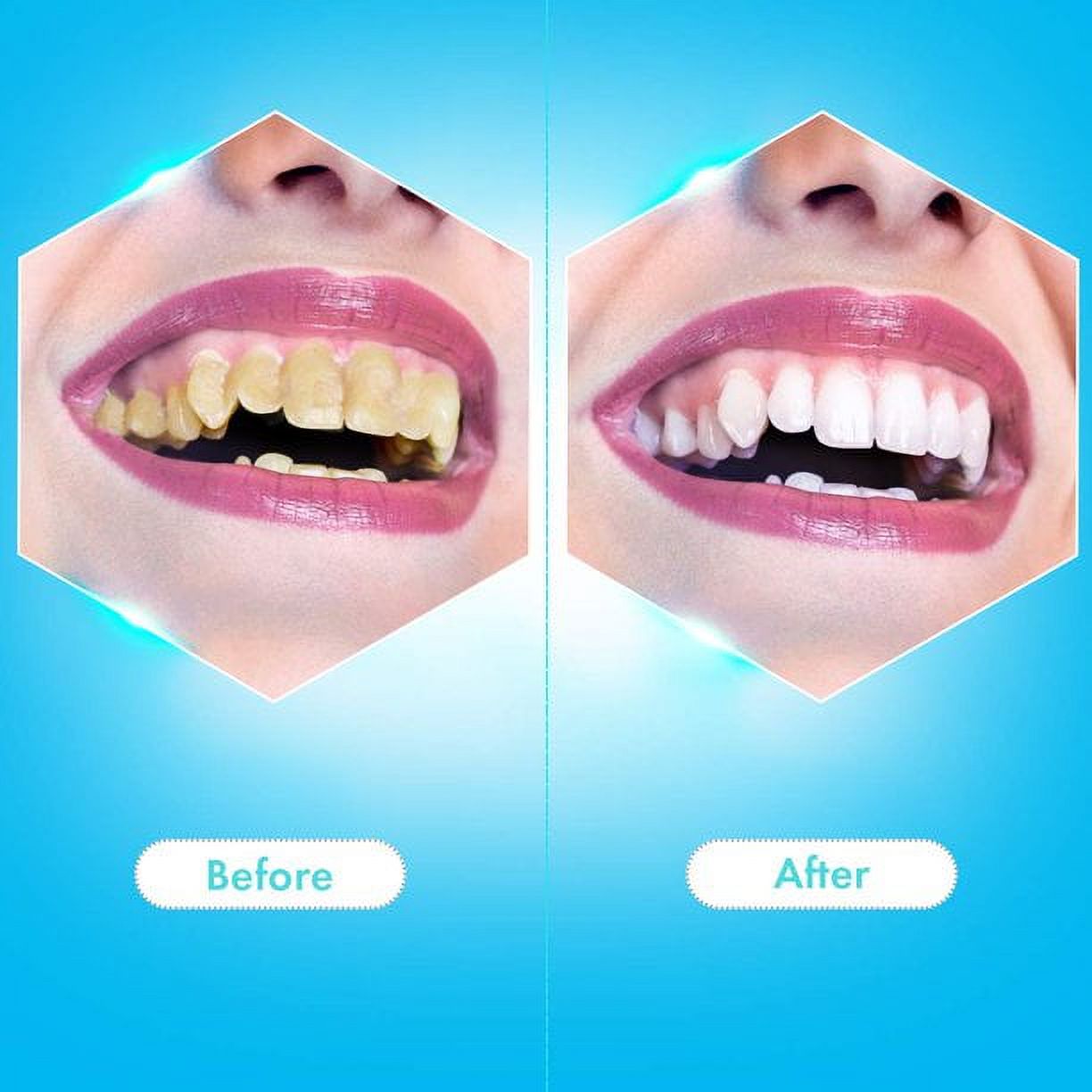 POINTERTECK Electric Dental Calculus Remover, Plaque Remover for Teeth Teeth Cleaner Tooth Tartar Scraper with 6 Replaceable Clean Heads