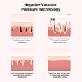 thumbnail image 4 of Removedor de espinillas faciales Seitruly herramienta eléctrica recargable con cabezales de repuesto Type2 NO2, 4 of 6