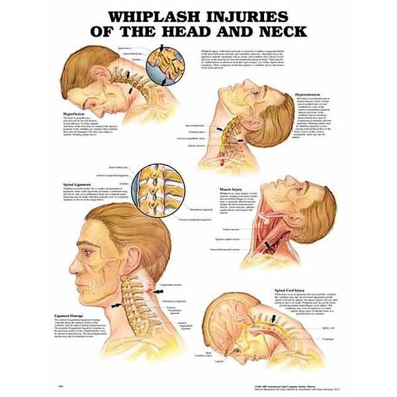 Whiplash Injuries of the Head and Neck Anatomical Chart
