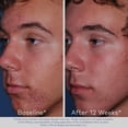 thumbnail image 3 of Limpiador espumoso para el acné Obagi ClenziDerm M.D. Daily Care, 3 of 5