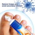 thumbnail image 5 of 20g Crema para hongos en las uñas Removedor de hongos en las uñas Crema removedora de hongos en las uñas de los pies, 5 of 5