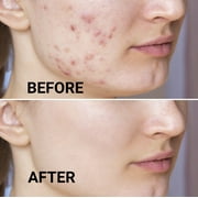 Dermatouch Acne Moisturizer Anti Aging Cream with Salicylic Acid and Oatmeal, 1.7 Oz.