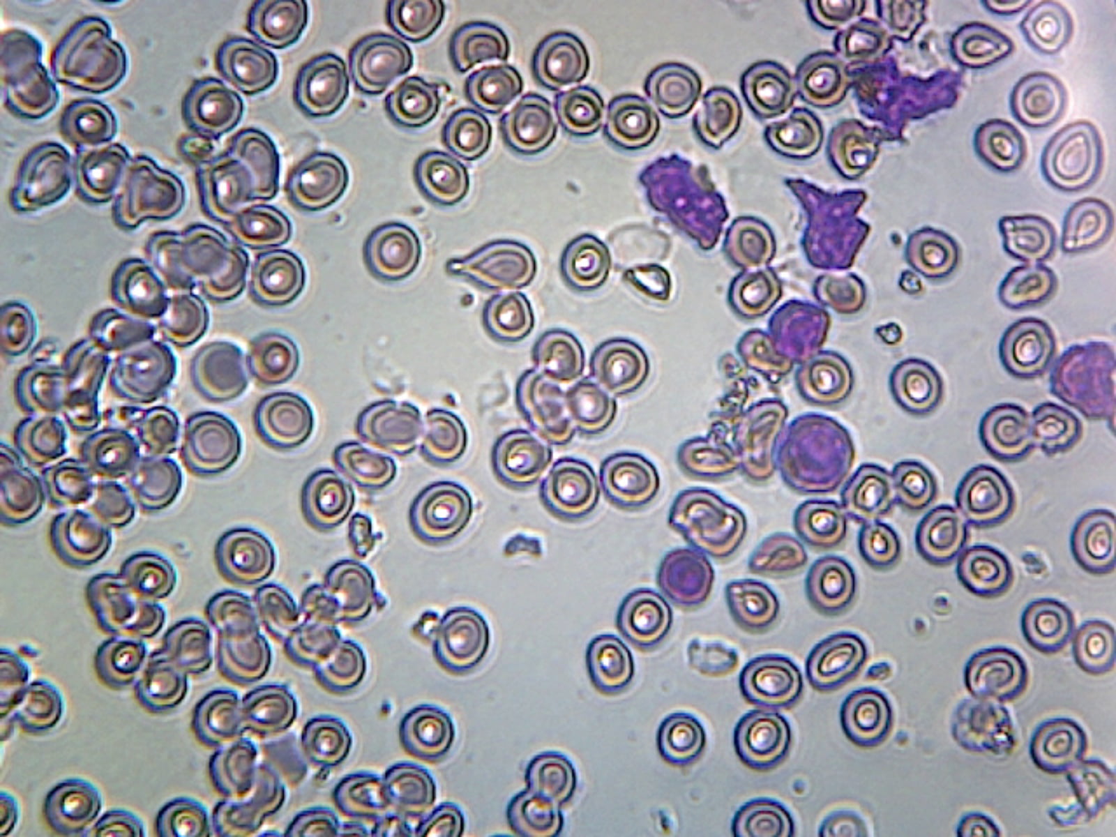 Acute Lymphatic Leukemia Smear From Blood Gs Stain Showing