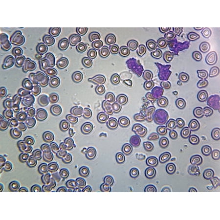 Slide   Acute Lymphatic Leukemia; Smear (From Blood); GS Stain; Showing Abnormal Lymphocytes by Go Science Crazy price history on PriceWatchPro
