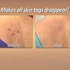 Bescita 10PC Small Clip Copper Tag Out Skin Tag Remover Skin Wart Tag Tattoo