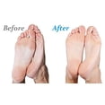 thumbnail image 4 of Eliminador de callos Emjoi Micro-Pedi 3D POWER con Xtreme Coese, 4 of 6
