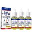 thumbnail image 1 of 1-3pcs Fungal Nail Treatment Highly Effective Kill Nail Fungus For Best Result, 1 of 5