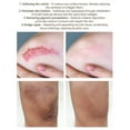 GARENAS Crocodile Repair Scar Cream Removal Scar Acne Treatment Marks