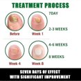 thumbnail image 4 of 7days Nail Treatment, Ginger Nail Treatment, Multi-purpose Nail Repair, Nail Nutrient Oil Strengthener Oil Serum Ginger Nail Growth Oil, 4 of 5