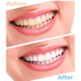 thumbnail image 3 of Kit de blanqueamiento de dientes Dientes de luz fría Tipo U Cabezales Blanqueador de dientes Limpiador de dientes, 3 of 5