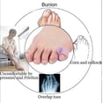 thumbnail image 2 of 10 Pack Little Toe Splint, Gel Toe Separator, Little Toe Straightener Hammer Toe, 2 of 5