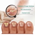 thumbnail image 2 of Fungal Nail Treatment, Extra Strong Nail Fungus Treatment For Toenail, Nail Repair -30ml, 2 of 5