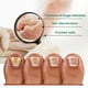 thumbnail image 2 of Fungal Nail Treatment, Extra Strong Nail Fungus Treatment For Toenail, Nail Repair -30ml, 2 of 5