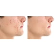 thumbnail image 2 of Nu Aura Skincare Acne Calming Face Kit - Balance & Soothe Acne Prone Skin Without Drying or Flaking! Get Clear Skin!, 2 of 5