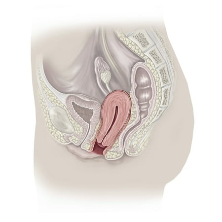 Sagittal section of pelvis showing prolapsed uterus Poster Print by TriFocal CommunicationsStocktrek