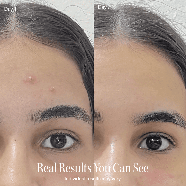 Solawave Bye Acne Spot Treatment, Red & Blue Light Therapy photo 8