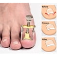 thumbnail image 4 of Herramienta de corrección para levantar uñas encarnadas, tratamiento para paroniquia, corrector, restauración, cuidado de las uñas de los pies, herramienta de pedicura, 4 of 5