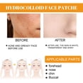 thumbnail image 3 of Jumpingount Parche para el acné Facial, pegatinas universales para la frente, cuidado de la piel, belleza, eliminación autoadhesiva, parches Tratamientos faciales, 3 of 6