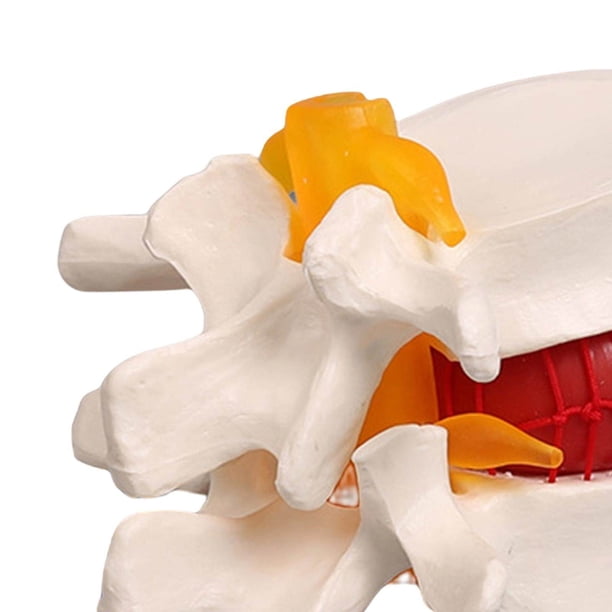 Disc Model Back ziyahi Lumbar Disc Herniation Model Lumbar Spine Model for Learning ...