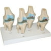 Walter Products 4 Stages of Knee Joint Diseases Model
