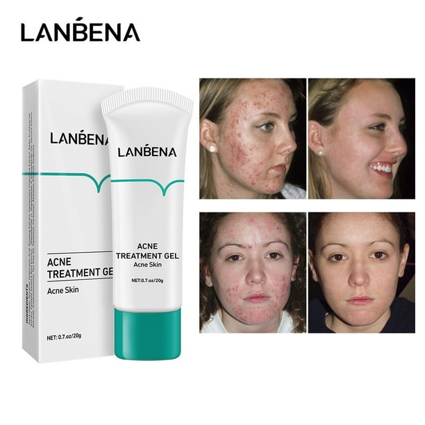 Lanbena azul en gel para el acné la-122
