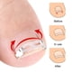 thumbnail image 4 of Kit corrector de uñas encarnadas para uñas curvas, hebilla de armadura de acero inoxidable, herramienta para enderezar uñas encarnadas., 4 of 8