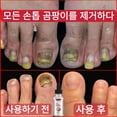thumbnail image 5 of West & Month-Tratamiento de hongos Nailr, esencia para el cuidado de los pies, Gel antiinfección para la eliminación de hongos en las uñas de los pies, paroniquia y onicomicosis, 5 of 5