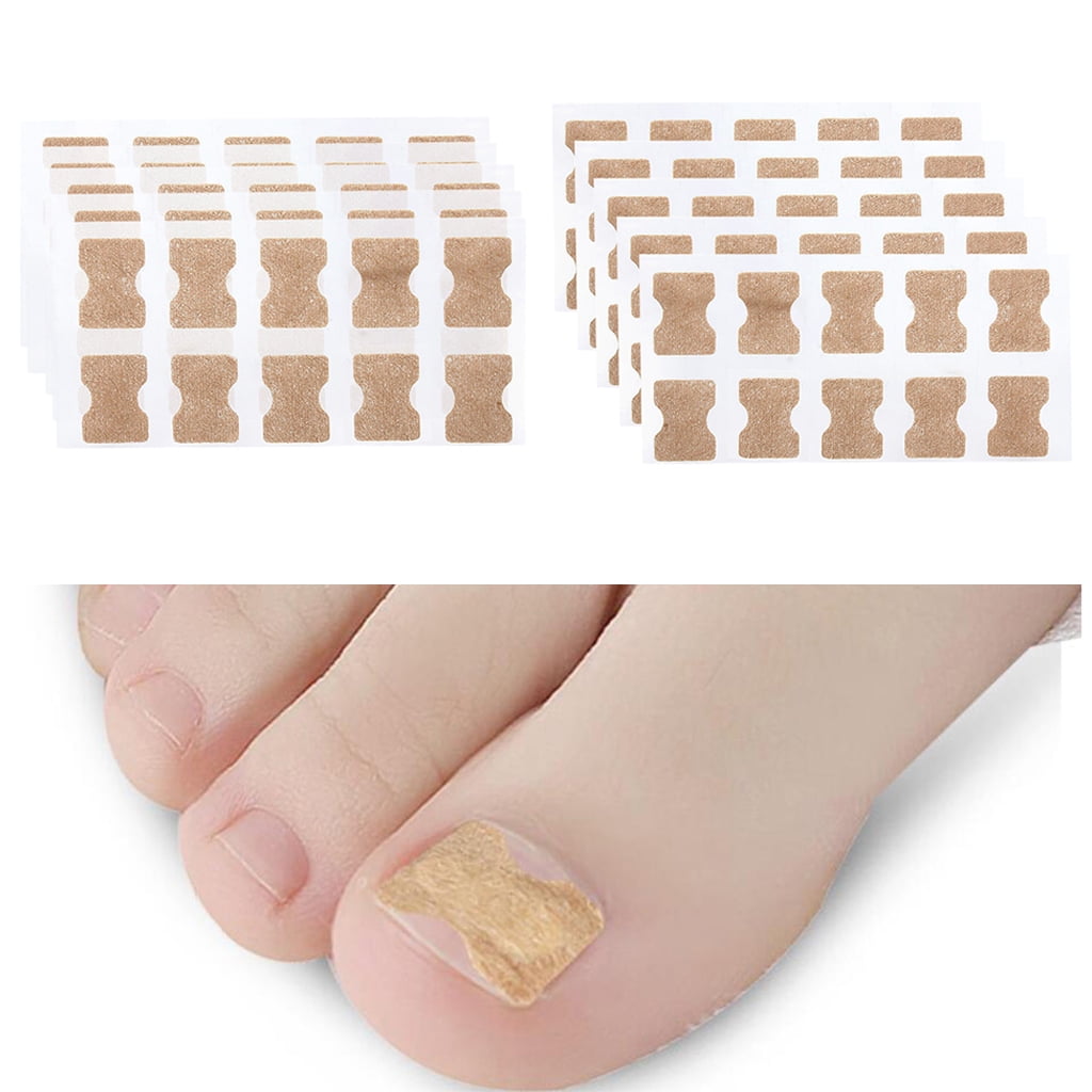 Ingrown Toenail Correction Stickers, Gluefree Ingrown Toenail Corrector Strips Painless