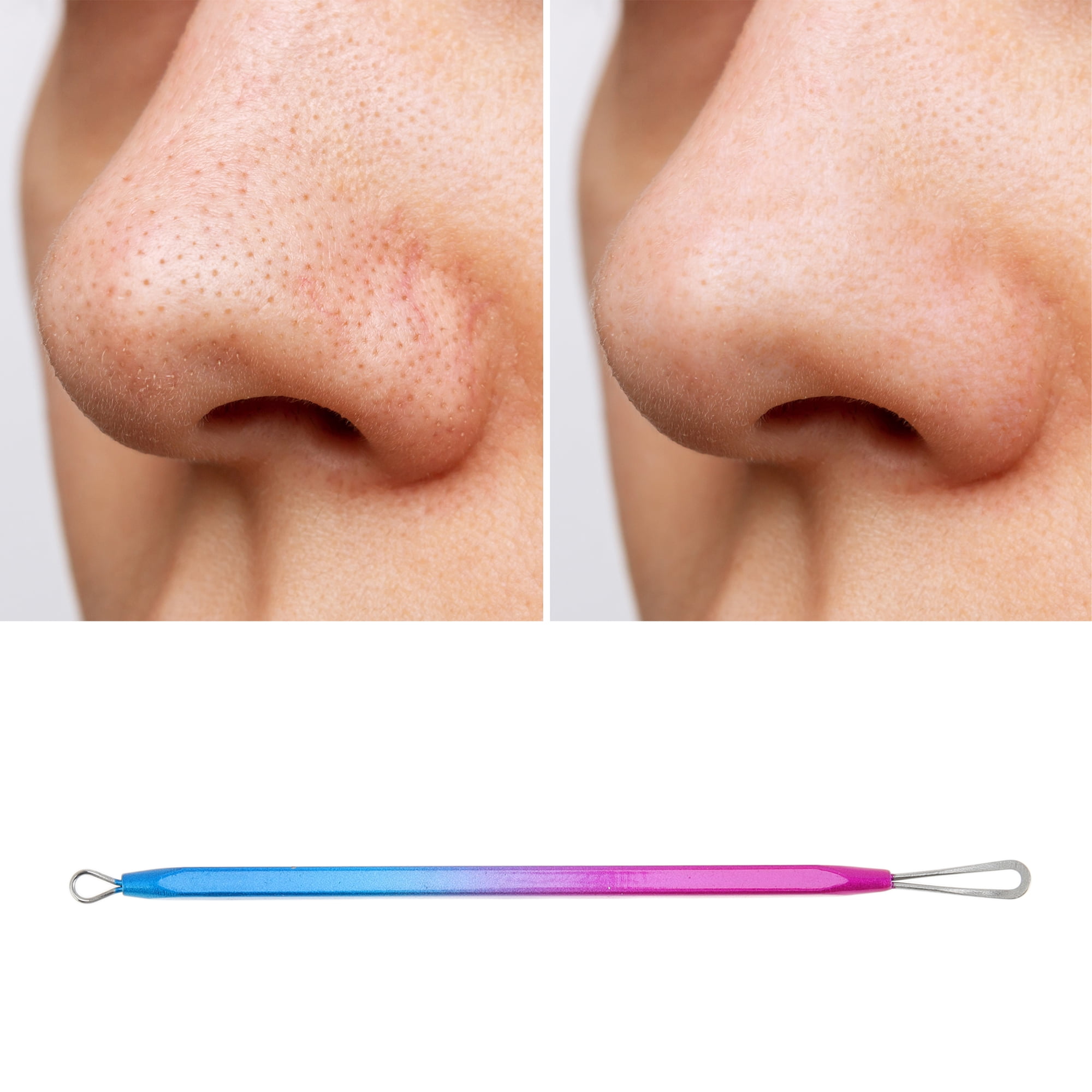 Unique Bargains 1pc Portable Squeeze Pimple Extractor Tool for Clear Skin Blue Purple