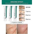 thumbnail image 4 of Breylee Acne Scar Removal Cream: 30g, Skin Repair (1pcs), 4 of 5