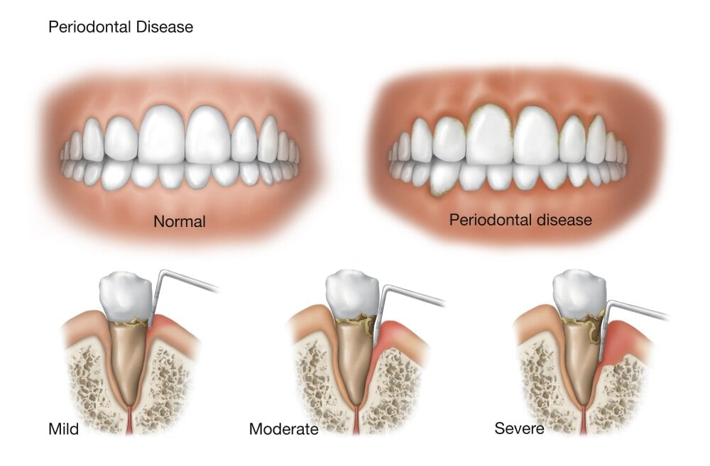 Three Stages Of Periodontal Disease Poster Print By Trifocal
