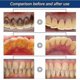 thumbnail image 4 of Suitable for Calculus Dissolving Dental Spray, 30ml Oral Tooth Cleaner Tartar Remover-jc, 4 of 4