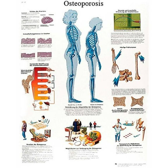 Fabrication B2138005 3B Anatomical Chart - Osteoporosis, Laminated