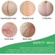 thumbnail image 5 of Hojas de silicona para eliminar cicatrices, 5 of 7