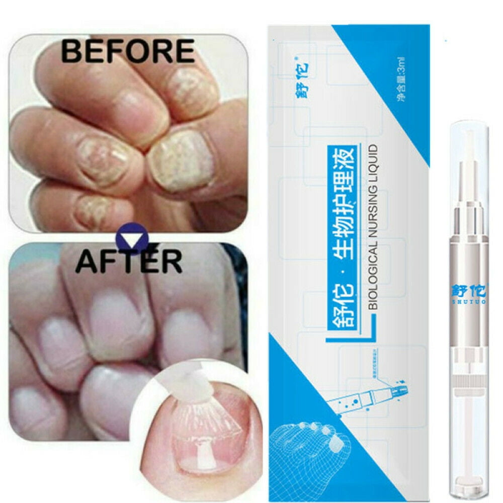 Anti Fungal Home Treatment Set Blue Light Laser Pen Anti Fungus Repair Serum Walmart Com