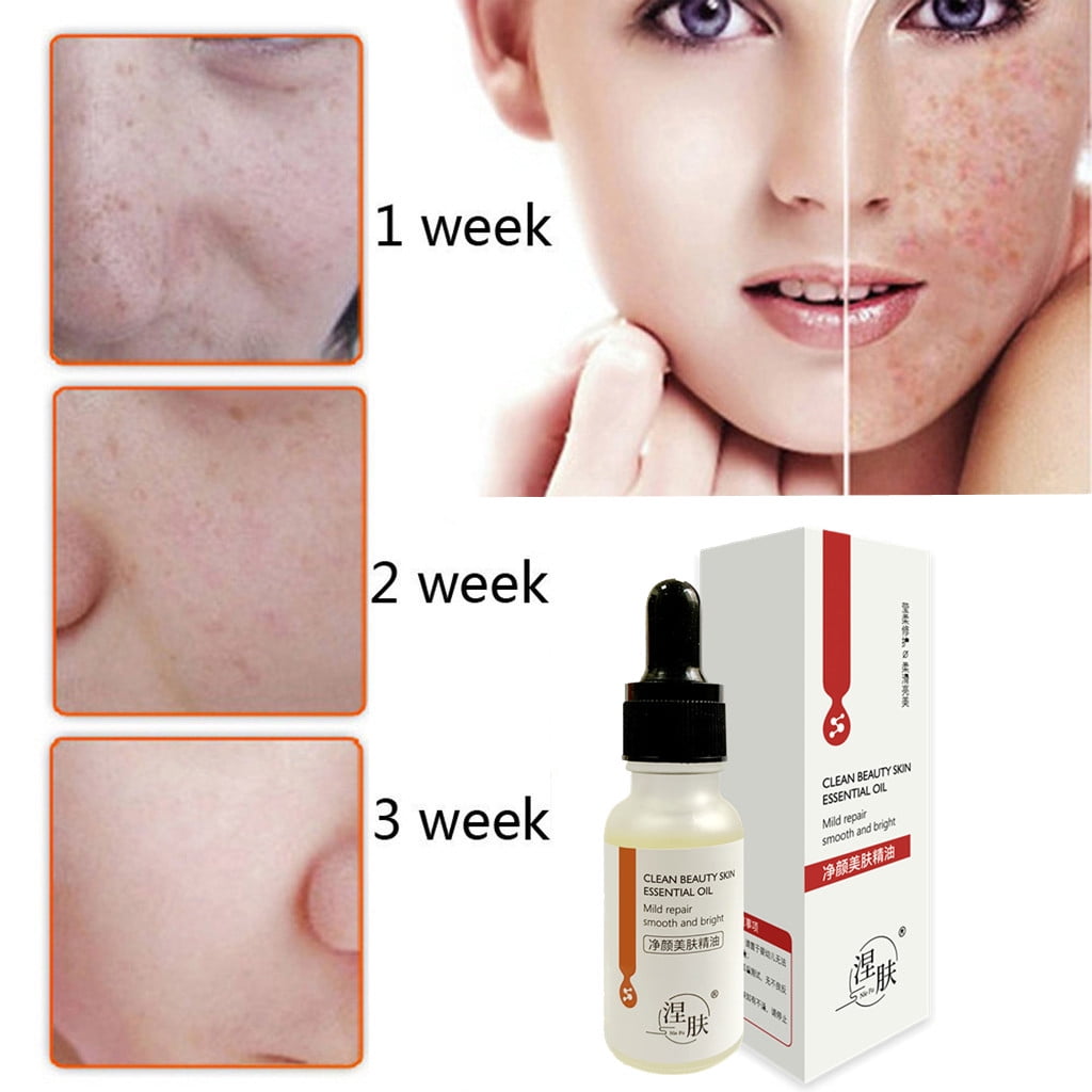 Ultra Oil Dark Spots Removal Age Spots Hyper 20ML