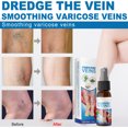 thumbnail image 2 of Paquete De 3 Aerosoles Para Venas Varicosas, 30ml, Aerosol De Hierbas Naturales Para La Eliminación De Venas Varicosas Y Arañas Vasculares, Mejora La Circulación Sanguínea ANGGREK Varicose Veins Spray, 2 of 8