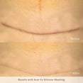 thumbnail image 3 of Rejuvaskin Scar Heal Kit - Scar Kit For Abdominal Scar - Scar Treatment for Soften, Flatten, Reduce and Recover Scars - Scar Gel, 1" x 22" Silicone Sheet & Medical Tape - Physician Recommended, 3 of 4
