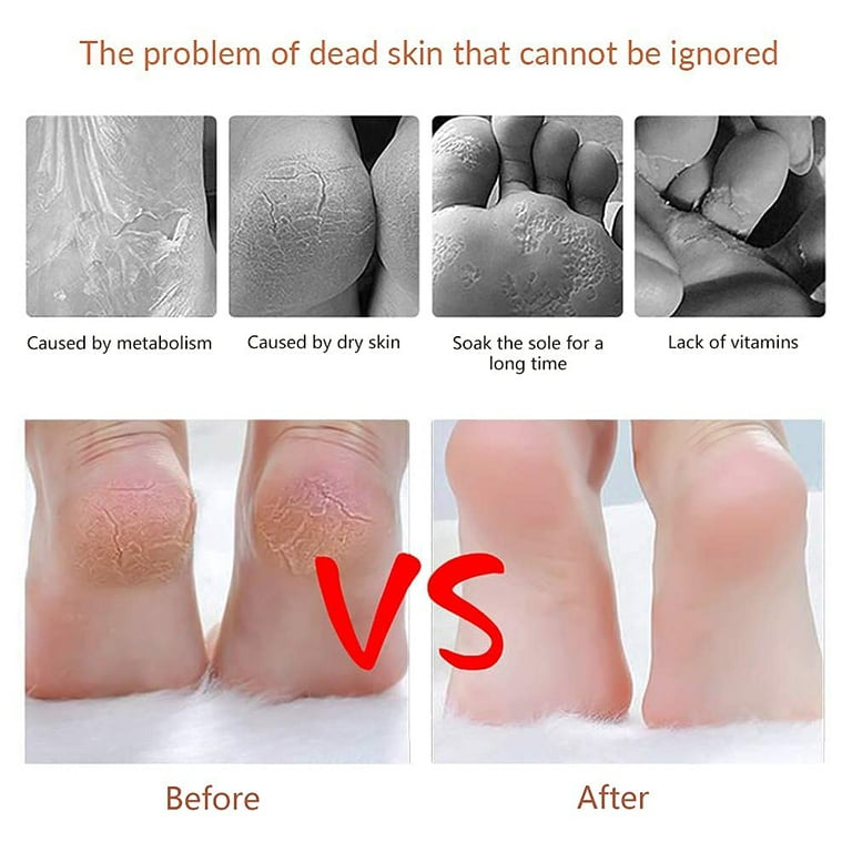 Callus Remover for Feet Dead Skin Remover Shaver Machine - Scalli™ 2.0 –  Roziyo®