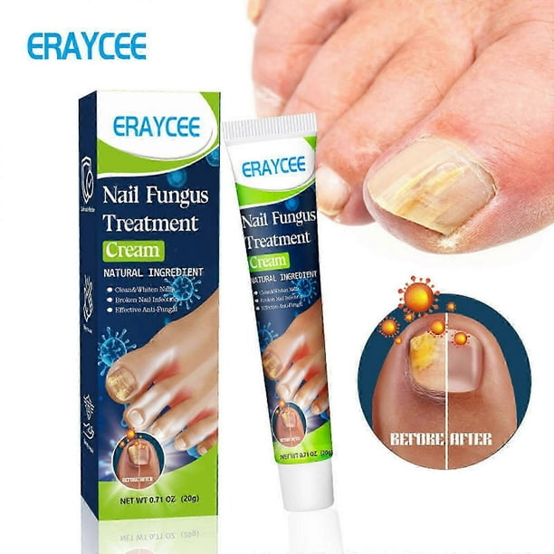 Fungus Nail Cream, Nail Repair Cream, Strong Anti-Fungal Toenail Cream,Nail Repair Nourishing Treatment,Restores Discolored and Damaged Nails 20g