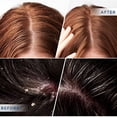 thumbnail image 3 of DERPHEA Psoriasis Shampoo, Seborrheic Dermatitis Shampoo, Antifungal Shampoo, Folliculitis Shampoo, Dry Scalp Shampoo, Safe Ingredients For All Skin Types, 3 of 6